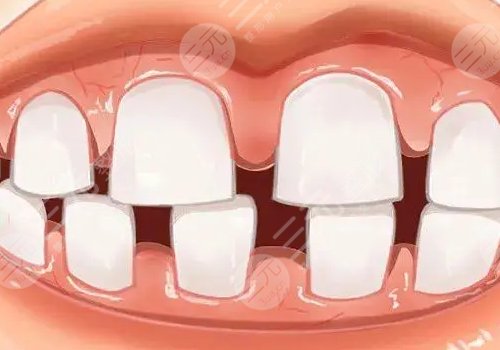 牙縫很大怎么辦?