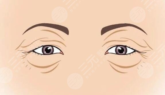 　　眼瞼皮膚松弛矯正術(shù)適合哪些人群?在開展緩解之前，越來越多的人都咨詢過這個問題，因為通過做該緩解，能夠讓眼部周圍的肌膚更加的緊致和光滑，不會出現(xiàn)松弛的感覺，而且也能夠讓整個人的皮膚狀態(tài)看上去更加的美觀和協(xié)調(diào)。但是做完緩解之后也有可能會出現(xiàn)一些后遺癥，所以適用的人群是不同。那么，眼瞼皮膚松弛矯正術(shù)適合哪些人群?一起來看!  　　一、眼瞼皮膚松弛是什么?  　　上眼瞼松弛多由于上眼皮脂肪過多所致，整個人眼部周圍的肌膚看上去是比較松弛的，沒有美觀的感覺。如果不進行及時的緩解和改良的話，那么整個人的皮膚會變薄然后變松，整個人的肌膚彈性會越來越小，松弛的程度也會更加的嚴重，整個人體的皮膚也會產(chǎn)生一定的萎縮。  　　二、眼瞼皮膚松弛矯正術(shù)適合哪些人群?  　　矯正手術(shù)適合人群，其實是比較多元化的，而且并非單純從年齡角度考慮，主要是看人體的眼角以及眉毛的松弛程度，也要看外眥皮膚松弛情況、上瞼重瞼松弛情況，然后根據(jù)實際狀態(tài)制定針對性的手術(shù)方案，然后再判斷是否可以進行矯正手術(shù)。  　　通過上瞼松弛矯正術(shù)，同時也可以通過眉上切口或眉下切口，能夠讓整個人的眼部協(xié)調(diào)感更好，同時能夠達到面部年輕化的效果，而且還能夠讓眼部周圍的肌膚更加的緊致。隨著求美人士對面部美容的關(guān)注，這種緩解方式能夠讓受術(shù)者得到更好的調(diào)節(jié)，并且皮膚狀態(tài)也會更加的美觀。  　　1、上眼瞼松弛多見于中、老年人，所以說這類人群一般是比較適合的。隨著年齡的增長，皮膚在慢慢的變薄，然后變得更加的松弛，所以說肌膚也缺乏彈性，這類人群的眼輪匝肌變性松弛、眼眶隔膜松弛萎縮，所以可以通過做該手術(shù)進行一定的改良和調(diào)。  　　2、眼瞼松弛尤其是上眼瞼松弛這類人群，也可以通過做這類緩解，進行一定的調(diào)節(jié)。嚴重的引起瞼裂變小，從而導致遮蓋瞳孔而影響視力影響視野，因此進行一定的改良，能夠讓肌膚更加的緊致，而且也能夠讓生活更加的方便。有的可見倒睫毛刺激眼球引起不適，通過做該手術(shù)可以更好的改良。眼瞼松弛影響美觀，也影響視野，所以做了這類緩解之后，皮膚也會更加的緊致，皺紋也會越來越少。  　　三、眼瞼皮膚松弛矯正術(shù)注意事項  　　上眼瞼松弛影響美觀影響視野，可以在專業(yè)醫(yī)生的指導下做手術(shù)進行一定的調(diào)節(jié)，但是一定要進行術(shù)前的檢查然后根據(jù)自己的實際狀態(tài)進行操作。手術(shù)后遵從醫(yī)囑，及時使用抗炎藥物，不能夠吃太多辛辣刺激性以及油膩的食物，避免感染發(fā)生，定期眼科檢查，如果出現(xiàn)了問題也要進行及時的緩解，而且傷口不能夠沾水，否則可能也會出現(xiàn)感染的。  　　做完緩解之后不能夠用力按壓自己肌膚，否則有可能會出現(xiàn)劇烈的疼痛感，還有可能會出現(xiàn)炎癥的現(xiàn)象，因此一定要進行針對性的護理，才能夠讓整個人的眼部周圍的肌膚更加的緊致，一旦出現(xiàn)了松弛，就要進行及時的干預(yù)和改良。日常生活中也要早一點休息，盡量減少熬夜，才能夠讓整個人的皮膚更加的健康。在熬夜的過程中，可能會出現(xiàn)內(nèi)分泌系統(tǒng)失調(diào)，周圍的肌膚狀態(tài)也會更加的衰老，還有可能會出現(xiàn)皺紋加重的現(xiàn)象，因此一定要早睡早起，調(diào)節(jié)好生活作息時間。