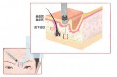 骨相抗衰注射什么好？醫(yī)美小課堂介紹，帶你一起體驗緊致美??！