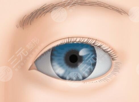 上眼瞼下垂矯正