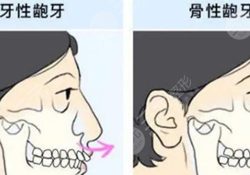 嘴凸怎么辦？