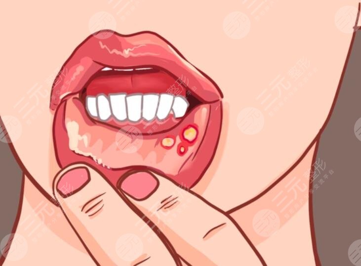 口腔潰瘍需要注意事項(xiàng)有哪些?