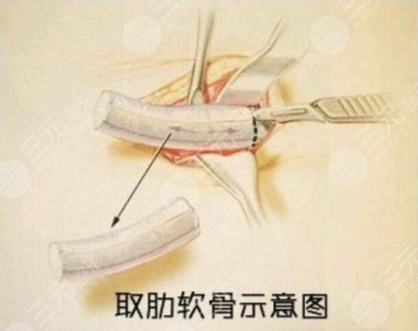 自體軟骨隆鼻好不好看?