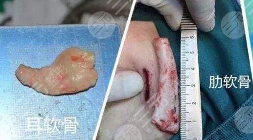 自體軟骨隆鼻好不好看?