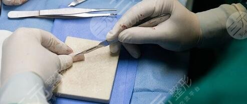 自體軟骨隆鼻有缺點嗎?