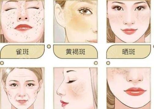 怎么祛斑不反彈?