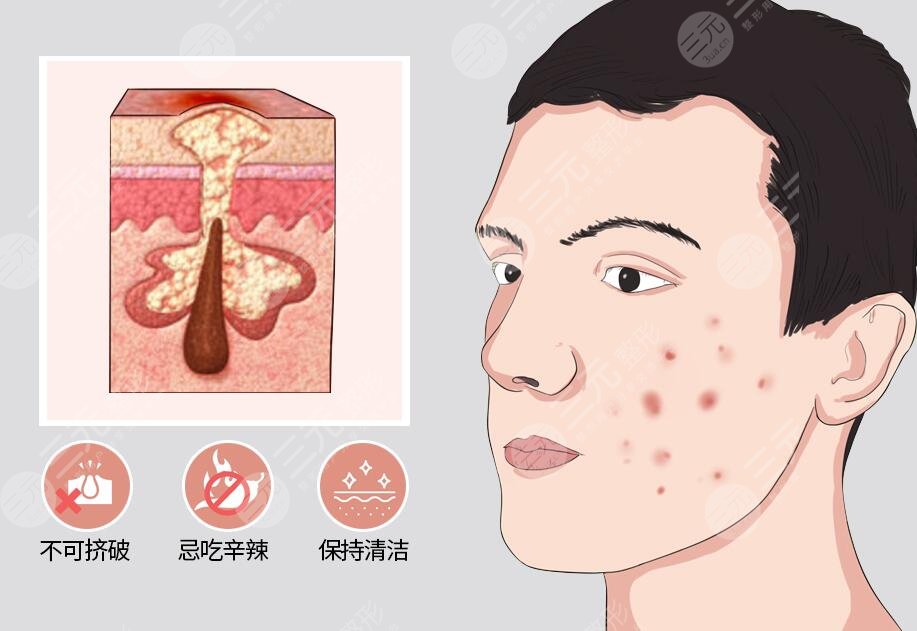 怎樣才能去除青春痘?