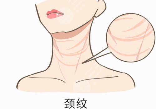 頸紋特別深怎么去除？
