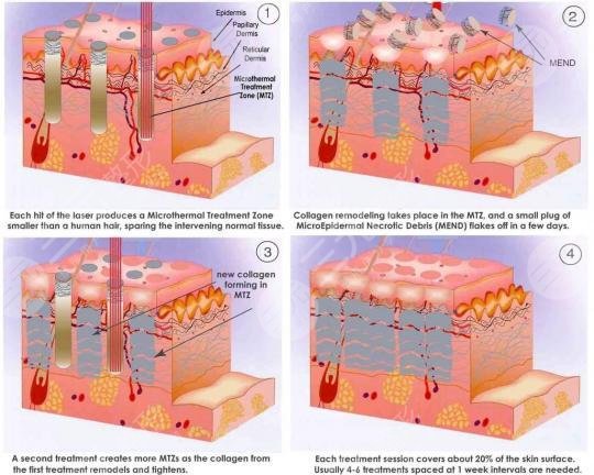 像素射頻儀器祛疤有用嗎？