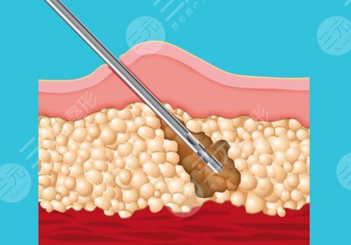 瘦小腿的方法有哪些？