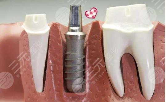 種植牙