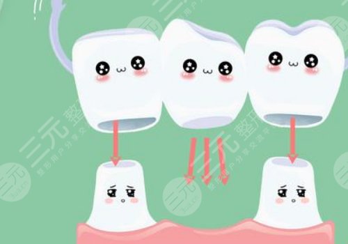 鈦合金烤瓷牙多少錢一顆？