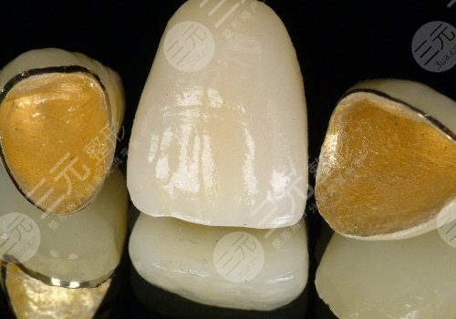 鈦合金烤瓷牙多少錢一顆？