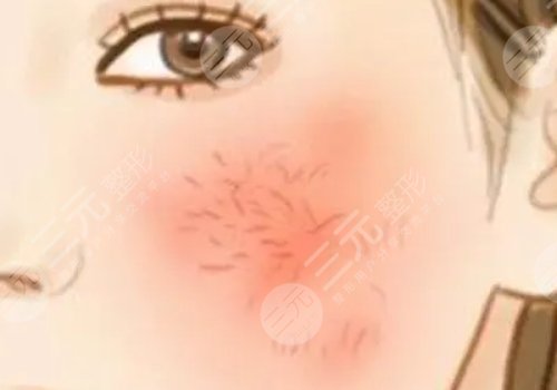 臉上長紅血絲怎么去掉？