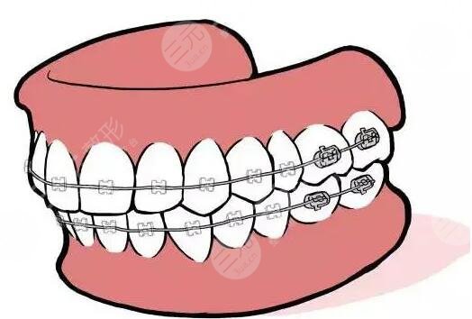 22歲還能矯正牙齒么？需要戴牙套多長時間？大概多少錢？