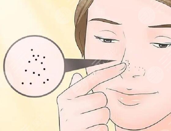 鼻子毛孔粗大還能恢復(fù)嗎?