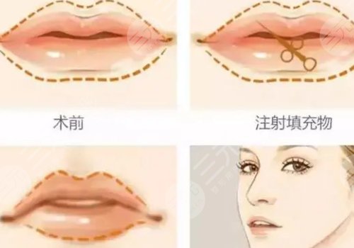 玻尿酸豐唇能維持多久？