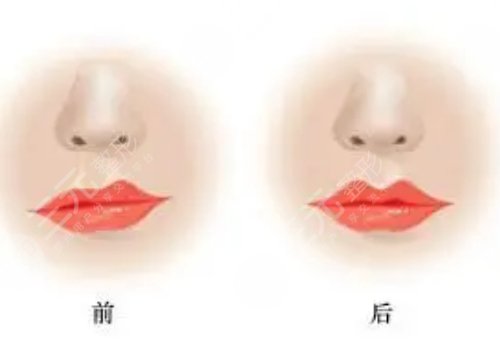 玻尿酸豐唇能維持多久？