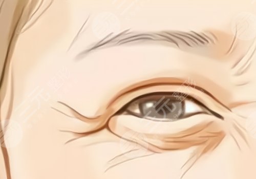 魚尾紋怎么才能去掉？