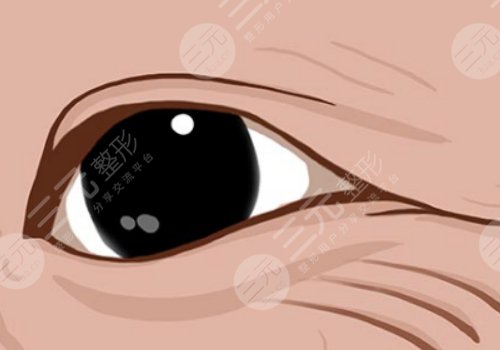 魚尾紋怎么才能去掉？