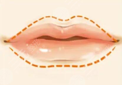 嘴唇角形有什么風(fēng)險(xiǎn)?