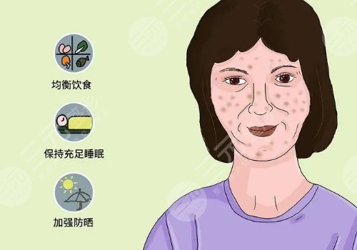 怎樣去除面部黃褐斑有效？