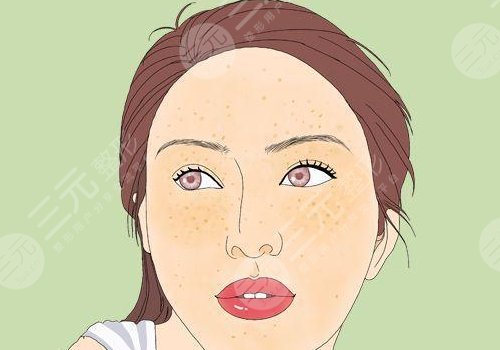 怎樣去除面部黃褐斑有效？