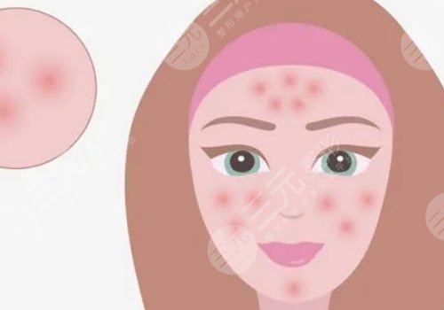 臉上有痘印怎么辦才能去掉呢？