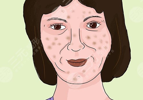 臉上的色斑怎么去掉(淡化)？