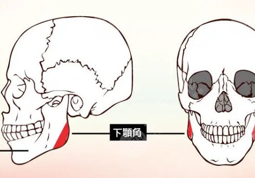 下頜角寬大怎么改良？