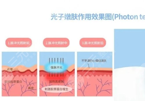 彩光嫩膚和光子嫩膚有什么區(qū)別？