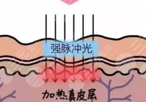 彩光嫩膚和光子嫩膚有什么區(qū)別？