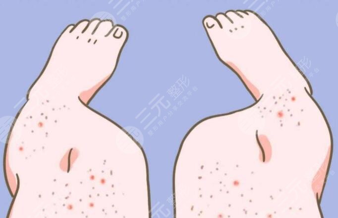 雞皮疙瘩皮膚怎么治比較好？雞皮疙瘩皮膚形成原因及日常護(hù)理