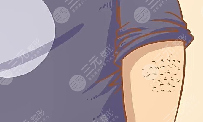 雞皮疙瘩皮膚怎么治比較好?