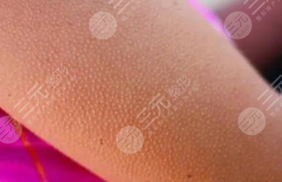 出現(xiàn)雞皮疙瘩應(yīng)該注意哪些問(wèn)題?