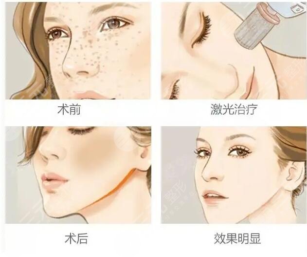 激光嫩膚多久可以做一次?