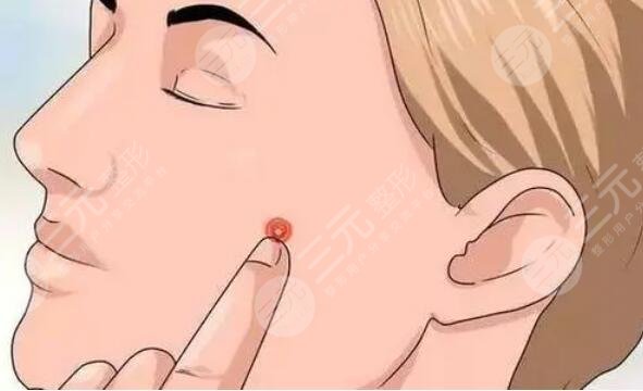 自制去痘面膜的配方做法大全，簡單易操作的方法快快get！