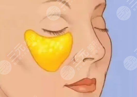 蘋果肌復(fù)位