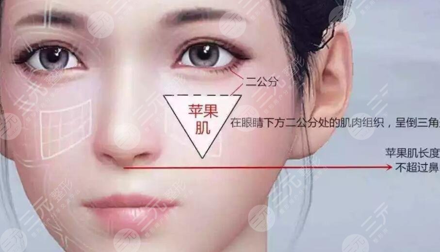 蘋果肌復(fù)位