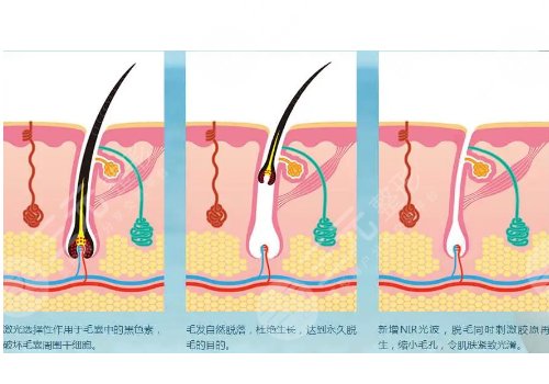 男士激光脫毛效果如何？