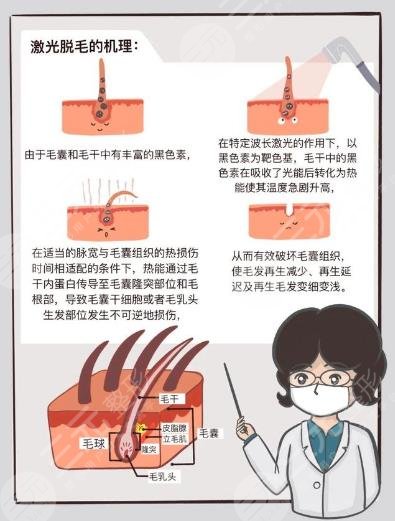 男士激光脫毛效果如何？