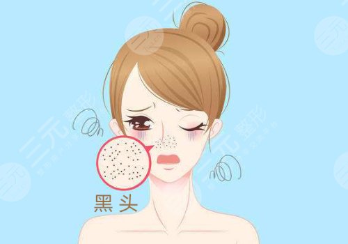 黑頭怎么去除有效？