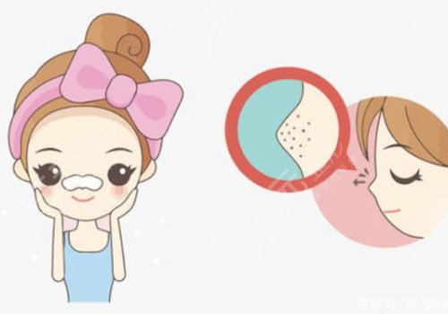 黑頭怎么去除有效？