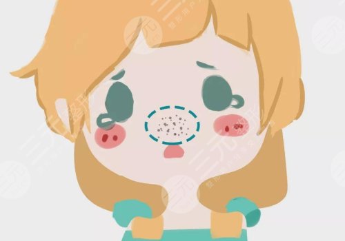 黑頭怎么去除有效？