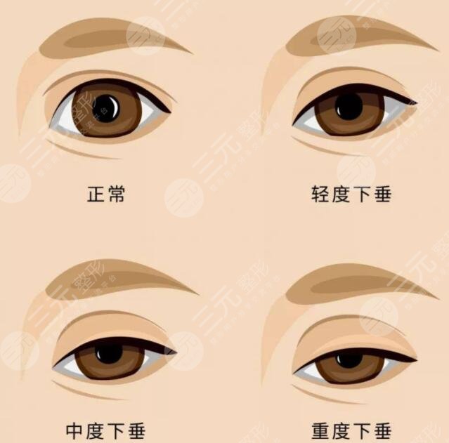 上瞼下垂矯正手術(shù)一般多少錢？價格決定因素有2點(diǎn)！