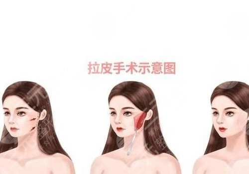 拉皮手術多大年齡做合適？