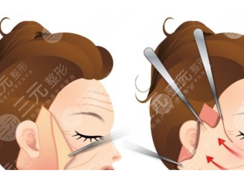 拉皮手術多大年齡做合適？