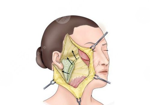 拉皮手術多大年齡做合適？
