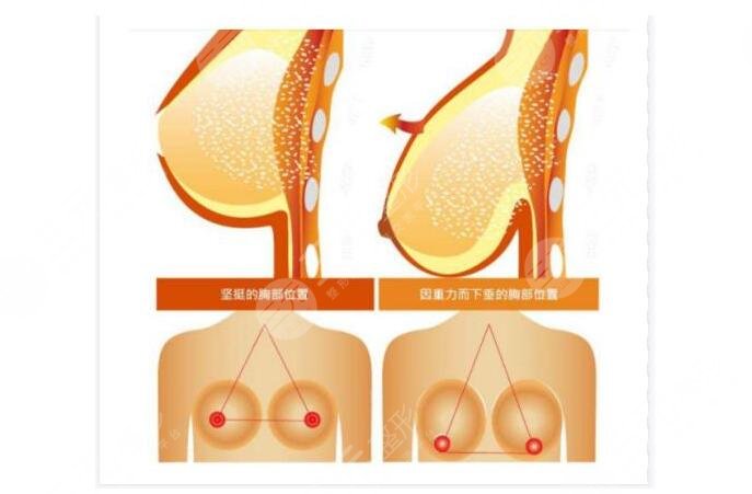 乳房懸吊術(shù)可以維持多久?