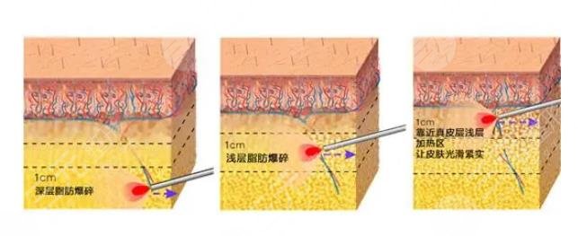 光纖溶脂的危害有哪些